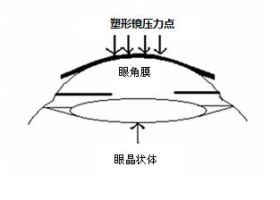 角膜塑形用硬性透氣接觸鏡說明書編寫指導(dǎo)原則(2020年修訂版)(2020年第47號)(圖1) 角膜塑形用硬性透氣接觸鏡說明書編寫指導(dǎo)原則(2020年修訂版)(2020年第47號)(圖1)