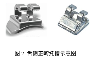 正畸托槽注冊(cè)審查指導(dǎo)原則（2022年第41號(hào)）(圖2)