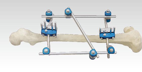 骨科外固定支架注冊技術審查指導原則（2018年修訂）（2018年第107號）(圖1)