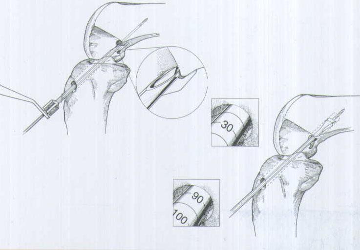 肌腱韌帶固定系統(tǒng)注冊(cè)技術(shù)審查指導(dǎo)原則（2020年第36號(hào)）